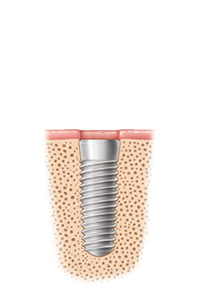 Interaktiver Ablauf Zahnimplantate 1 von 3